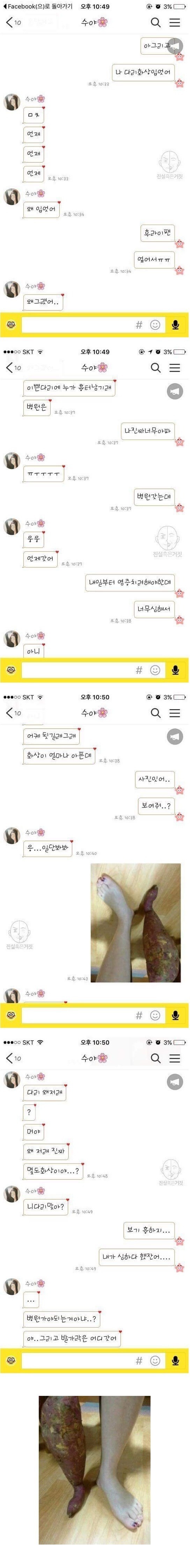 남자친구에게 화상 입었다고 거짓말을 해봤다 | 인스티즈