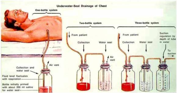 Chest Tube Insertion Closed Thoracostomy